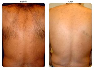 before after back hair removal