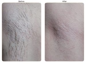 before after permanent hair removal