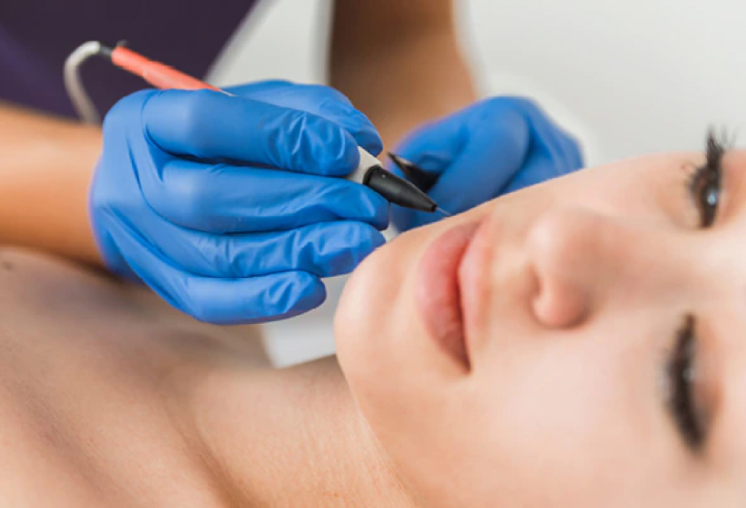 What Are the Different Techniques of Electrolysis Hair Removal? -